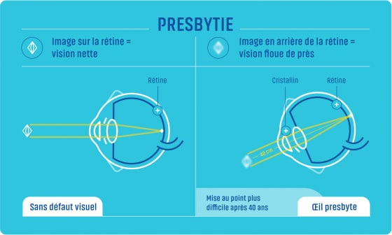 La Presbytie Tout Savoir De La Presbytie Et Des Solutions De Verres